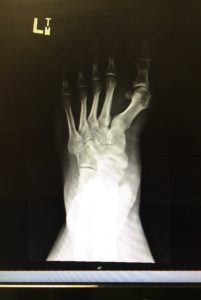 The inside of Joey's foot.