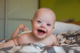 down syndrome baby